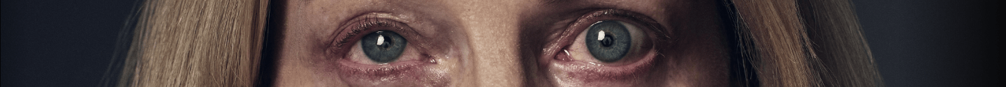 Depiction of misaligned and bulging eyes from Thyroid Eye Disease