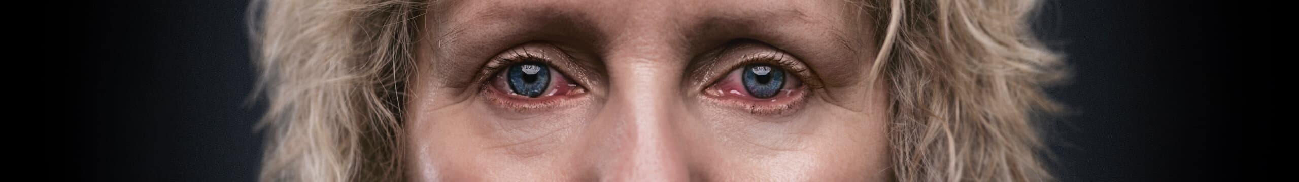 Depiction of red eyes from Thyroid Eye Disease