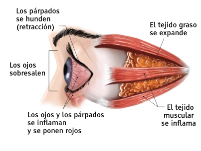 Eye during "acute" Thyroid Eye Disease phase