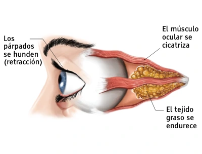 Eye during "chronic" Thyroid Eye Disease phase