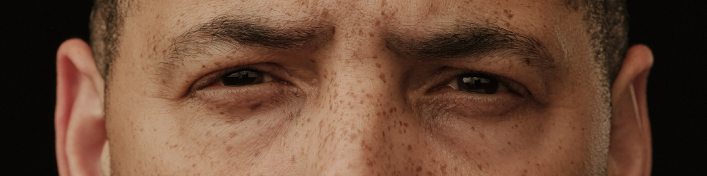 misaligned eyes thyroid eye disease