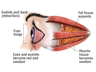 Eye during "acute" Thyroid Eye Disease phase