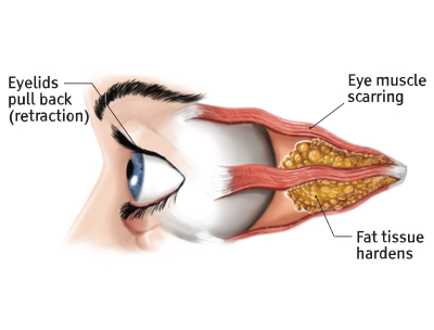 Eye during "chronic" Thyroid Eye Disease phase
