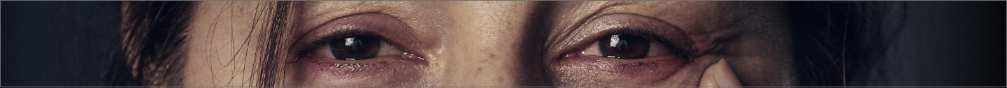 Una imagen de la enfermedad ocular tiroidea