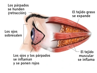 Ilustración de un ojo durante la fase “aguda” de la enfermedad ocular tiroidea