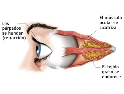 Ilustración de un ojo durante la fase “crónica” de la enfermedad ocular tiroidea 