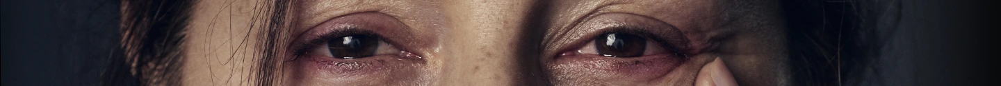Una imagen de la enfermedad ocular tiroidea