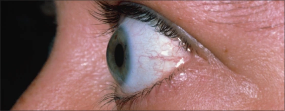 Fotografía horizontal de la enfermedad ocular tiroidea