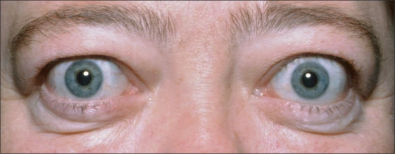Fotografía de la enfermedad ocular tiroidea