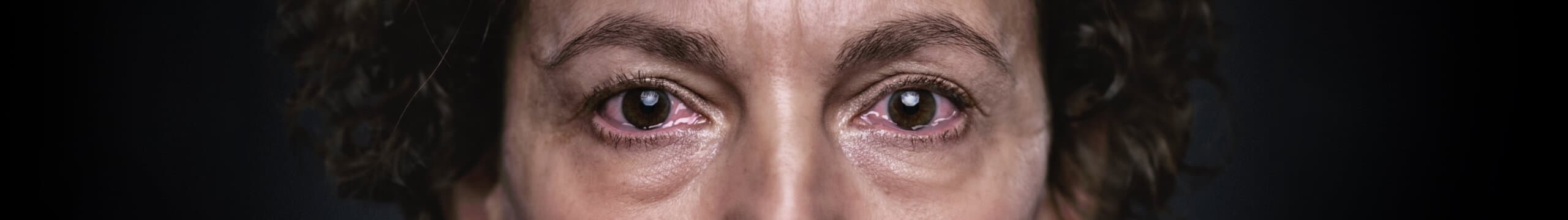 Depiction of red, teary eyes from Thyroid Eye Disease